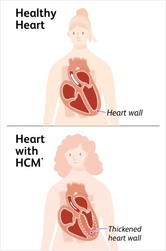 Illustration of a person with a healthy heart and a normal heart wall and a person with a heart with hypertrophic cardiomyopathy (HCM) and a thickened heart wall