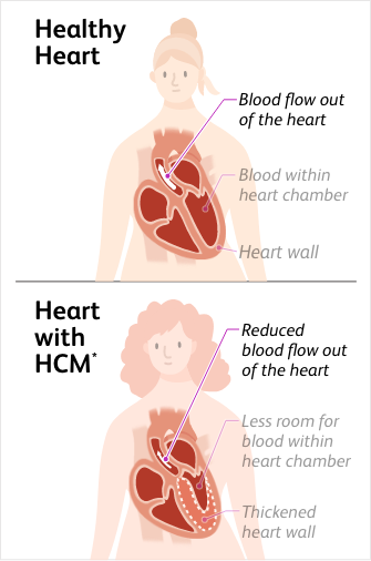 Illustration of a person with a healthy heart and normal blood flow out of the heart and a person with a heart with hypertrophic cardiomyopathy (HCM) and reduced blood flow out of the heart