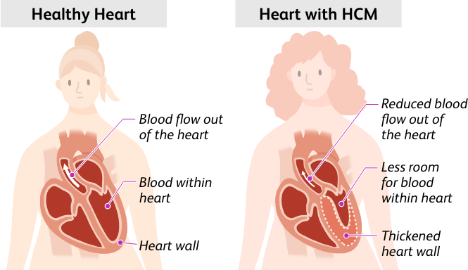 healthy heart and heart with hypertrophic cardiomyopathy (HCM)