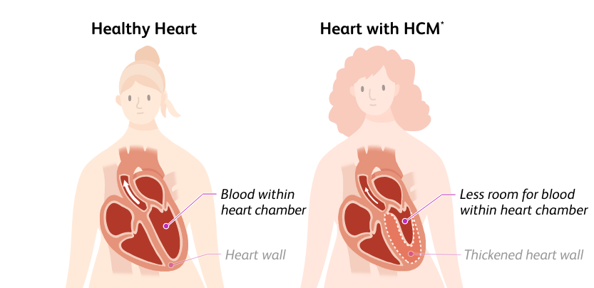 Illustration of a person with a healthy heart and a normal heart chamber and a person with a heart with hypertrophic cardiomyopathy (HCM) and less room for blood within their heart chamber
