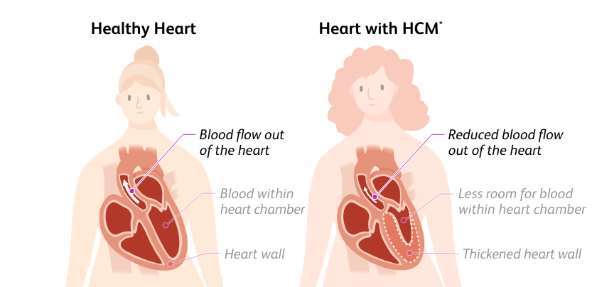Illustration of a person with a healthy heart and normal blood flow out of the heart and a person with a heart with hypertrophic cardiomyopathy (HCM) and reduced blood flow out of the heart
