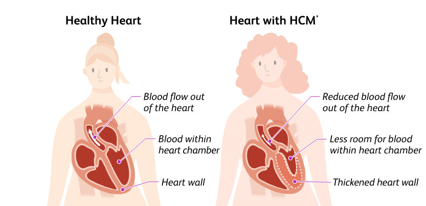 Illustration of a person with a healthy heart and a person with a heart with hypertrophic cardiomyopathy (HCM)
