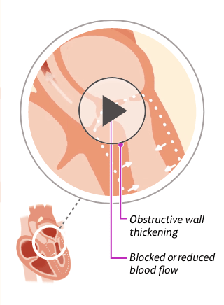 Illustration of a heart with obstructive hypertrophic cardiomyopathy (oHCM)